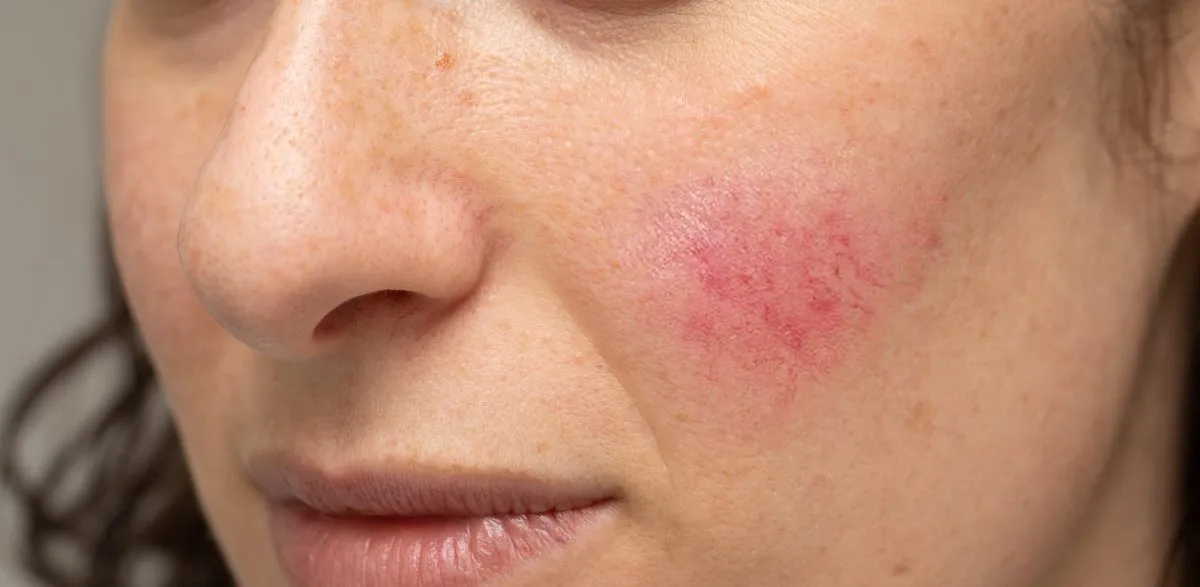 Rosacea treatment